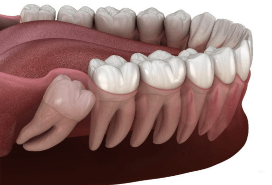 Dental Implants